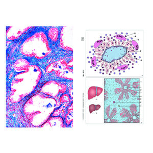 LIEDER Human diseases (Pathology), Basic Set of 6 slides, Student Set